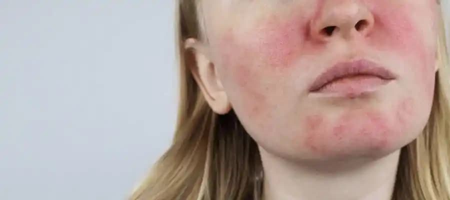 Gül Hastalığına Kalıcı Çözüm Yolları ve Kozmetik Yaklaşımlar