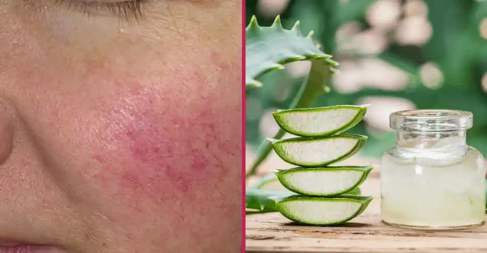 Gül Hastalığına Karşı Doğal Yağlar ve Cilt Bakım Önerileri