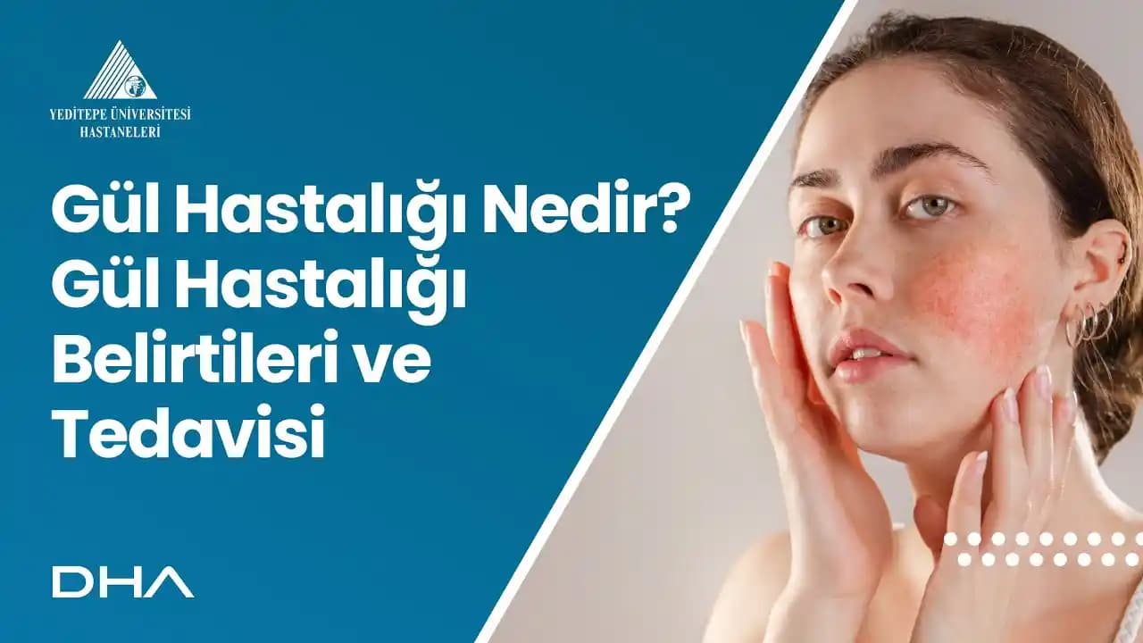Gül Hastalığında Uygun Beslenme ve Kaçınılması Gereken Gıdalar Hakkında Bilgiler