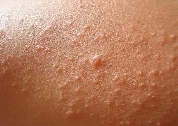 Güneş Alerjisi Nedir, Belirtileri ve Kozmetik Dünyasındaki Etkileri Hakkında Bilgi