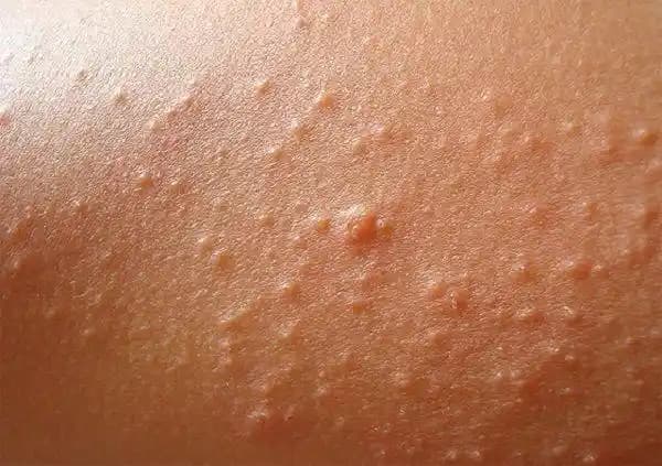 Güneş Alerjisi Nedir, Belirtileri ve Kozmetik Dünyasındaki Etkileri Hakkında Bilgi