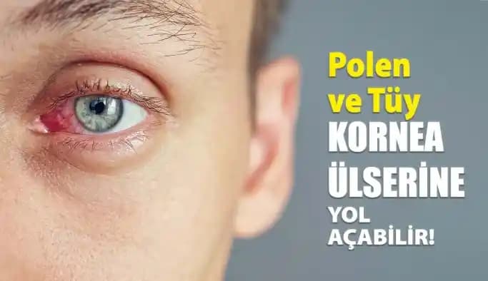 Güneş Alerjisi ve Göz Sağlığı: Korunma Yöntemleri ve Belirtiler