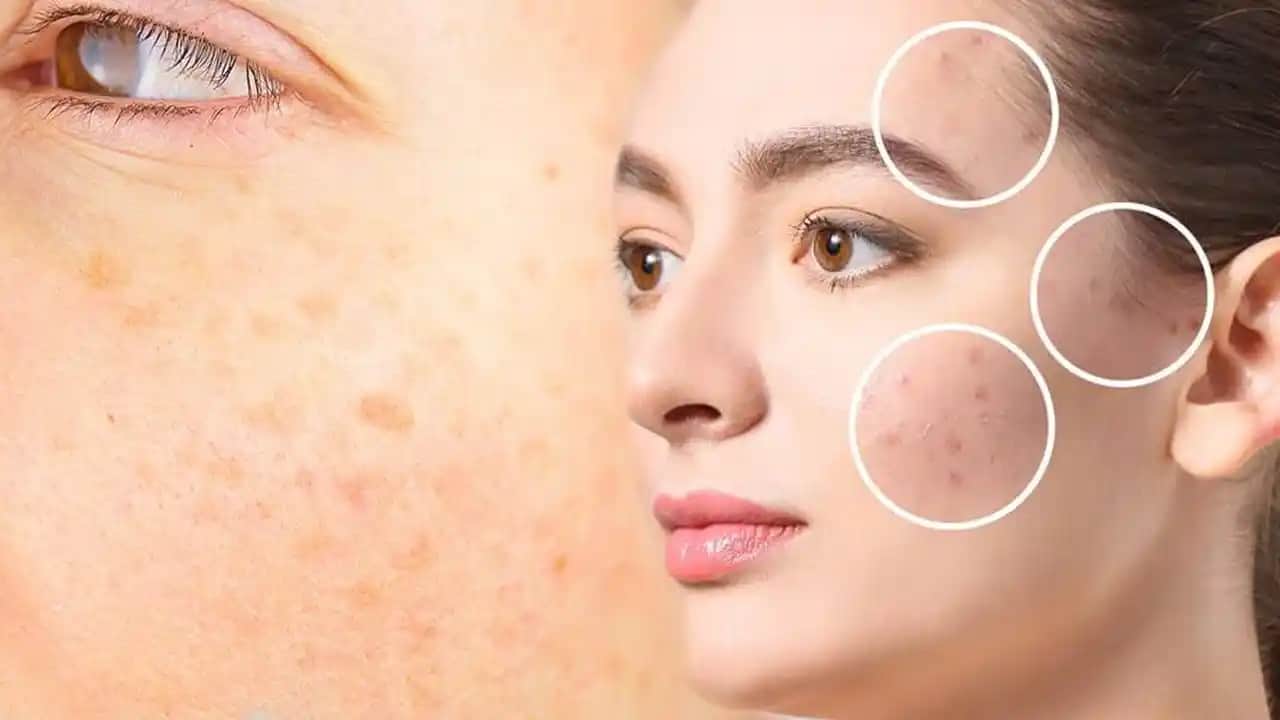 Güneş Lekeleri Nasıl Geçer ve Etkili Tedavi Yöntemleri Nelerdir