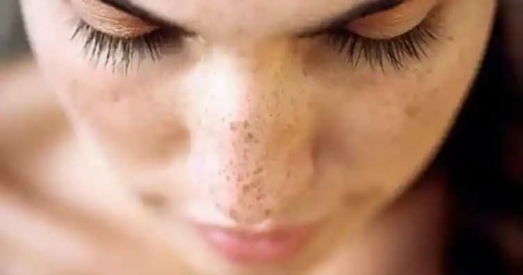 Güneş Lekelerine Karşı Etkili Çözümler ve Korunma Yöntemleri Hakkında Bilgiler