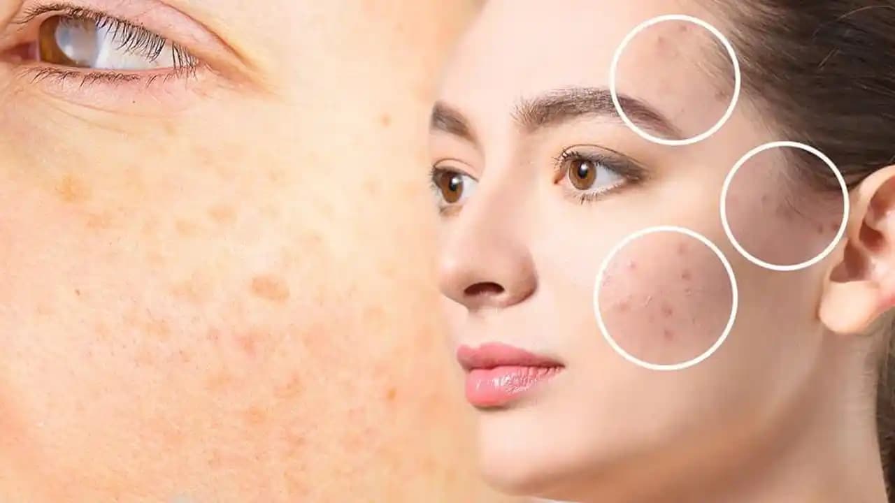 Güneş Lekeleriyle Mücadelede Etkili Yöntemler ve Koruyucu Önlemler