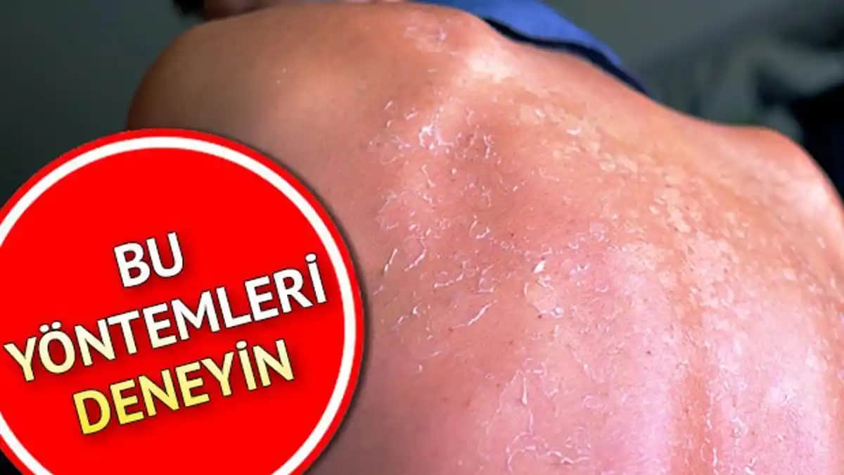 Güneş Yanığı Kızarıklığı Nasıl Geçer ve İyileşme Süreci Hakkında Bilgiler