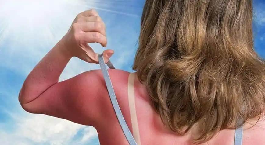 Güneş Yanığı ve Kaşıntısı İçin Etkili Doğal ve Medikal Çözümler Rehberi