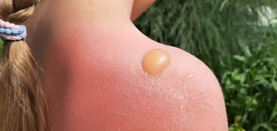 Güneş Yanığının Faydaları ve Güzellik ile Sağlık Arasındaki İnce Çizgi