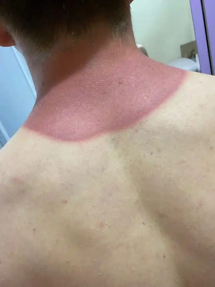 Güneş Yanmasının Kozmetik ve Cilt Sağlığı Üzerindeki Etkileri ve Koruma Yöntemleri