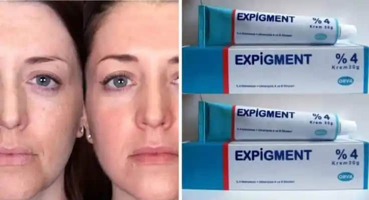 Hamilelikte Cilt Lekelerine Karşı Güvenli ve Etkili Krem Kullanımı Rehberi