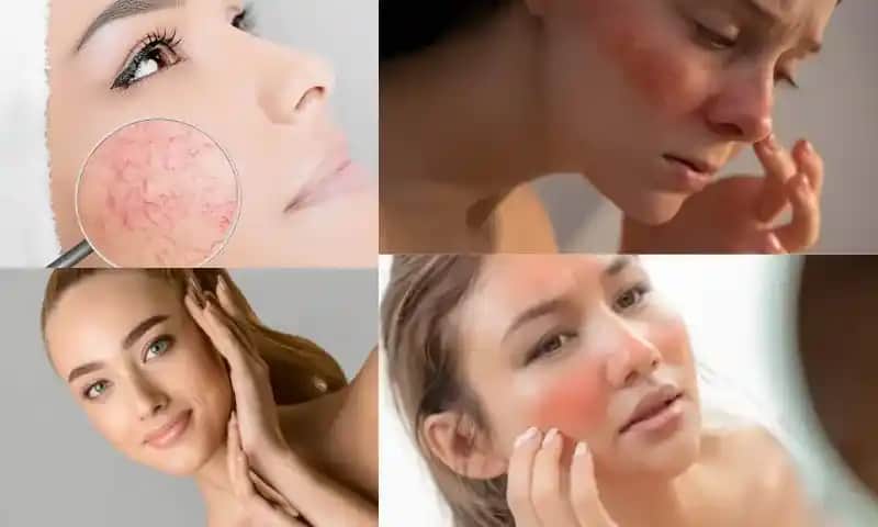 Hassas Cilt Belirtileri ve Doğru Bakım Yöntemleri ile Sağlıklı Cilt Rehberi