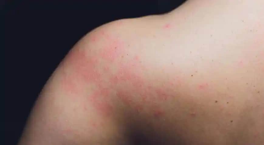 Havuz Sonrası Cilt Kızarıklığını Azaltmak ve Önlemek İçin Etkili Yöntemler