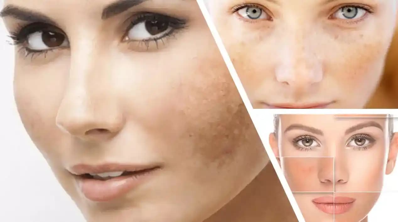 Hiperpigmentasyon ve Postenflamatuar Hipertansiyon: Nedenleri, Türleri ve Güncel Tedavi Yöntemleri