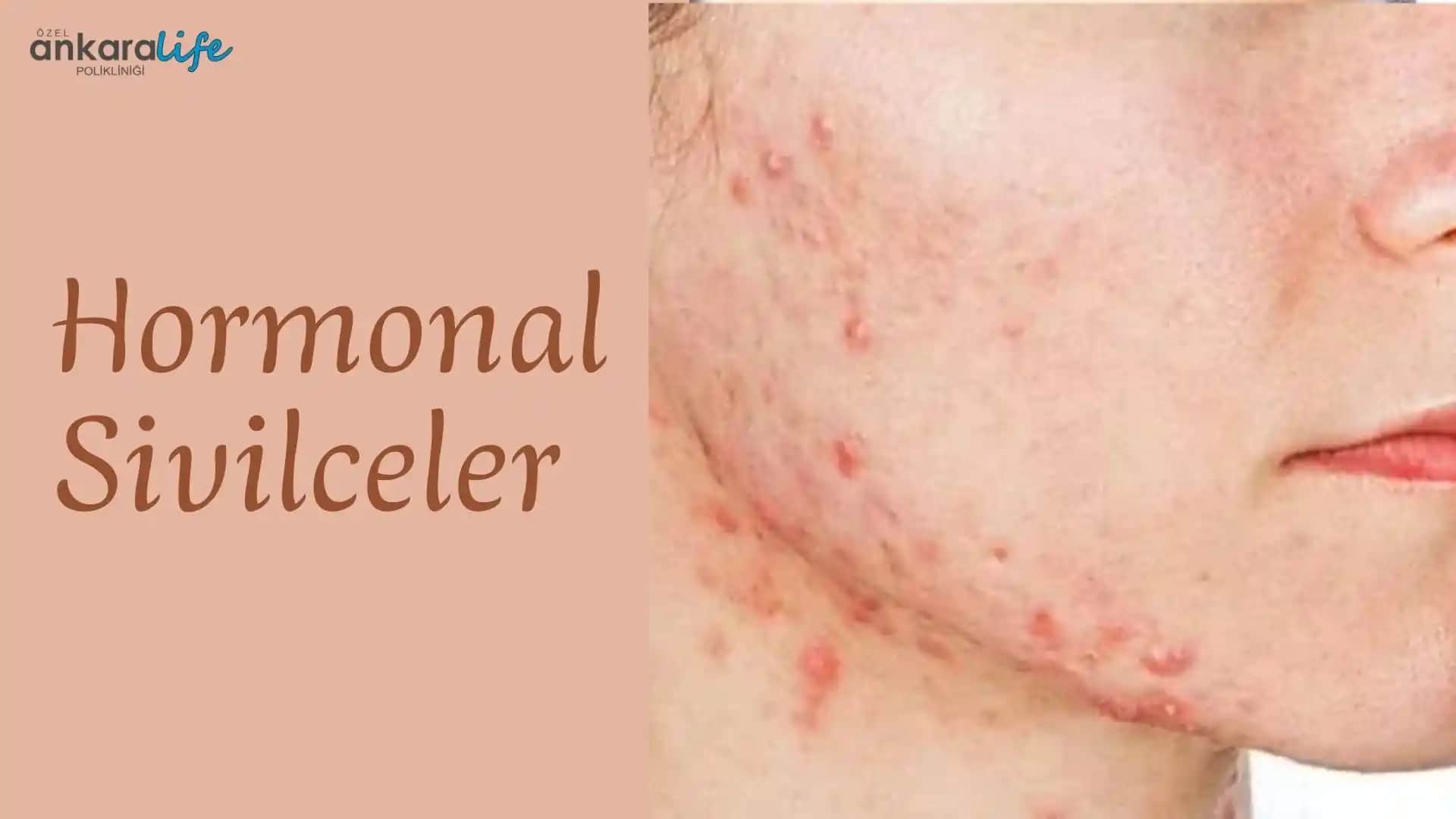 Hormon Bozukluklarının Sivilce Oluşumuna Etkisi ve Cilt Sağlığına Yönelik Çözümler
