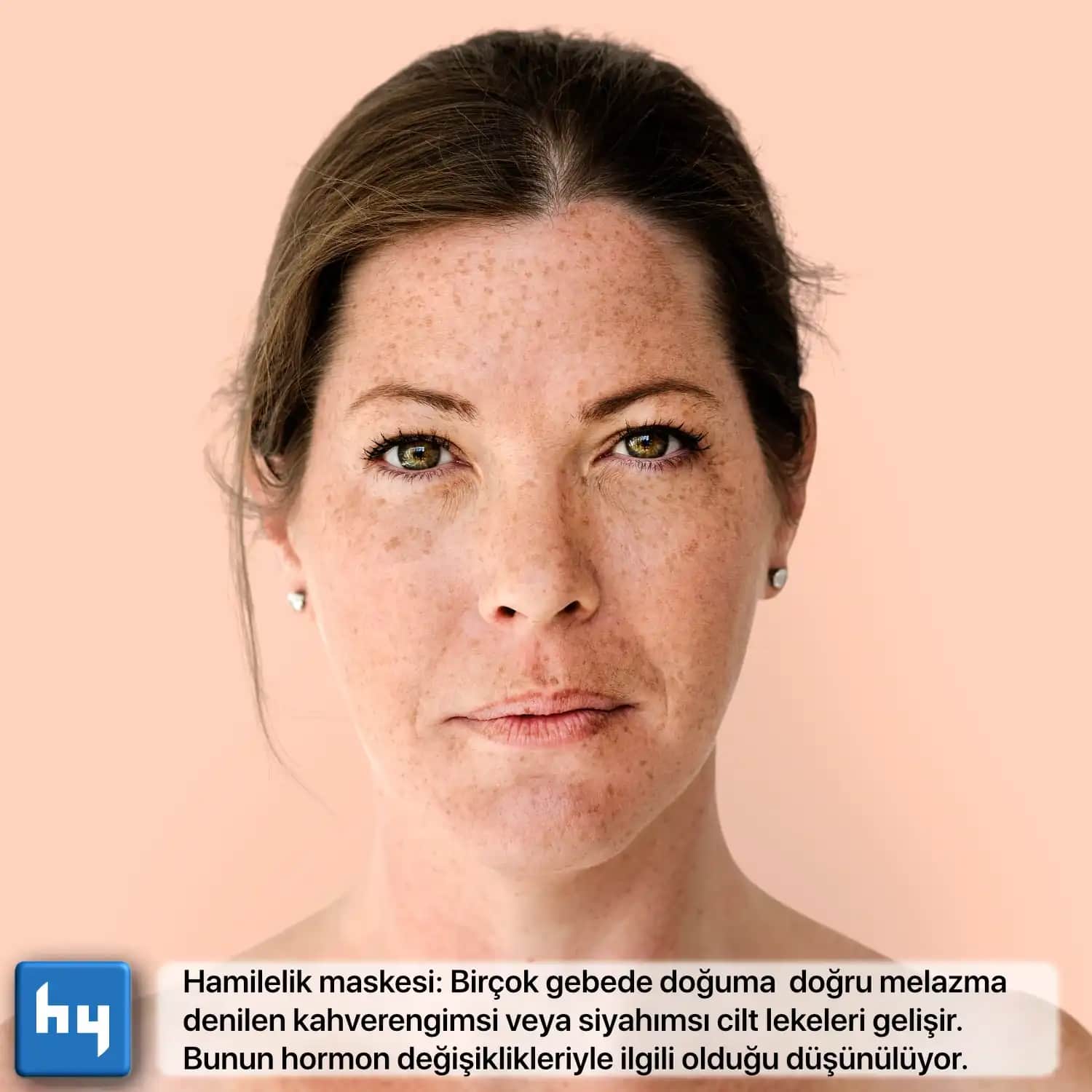 Hormon Dengesizlikleri ve Cilt Lekeleri: Nedenleri ve Çözüm Yolları