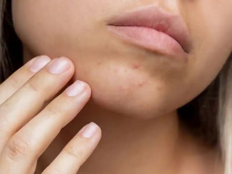 Hormonal Sivilceler Nasıl Anlaşılır ve Etkili Tedavi Yöntemleri Nelerdir