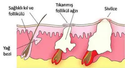 İçi Boş Sivilceler Nedir, Neden Oluşur ve Nasıl Tedavi Edilir