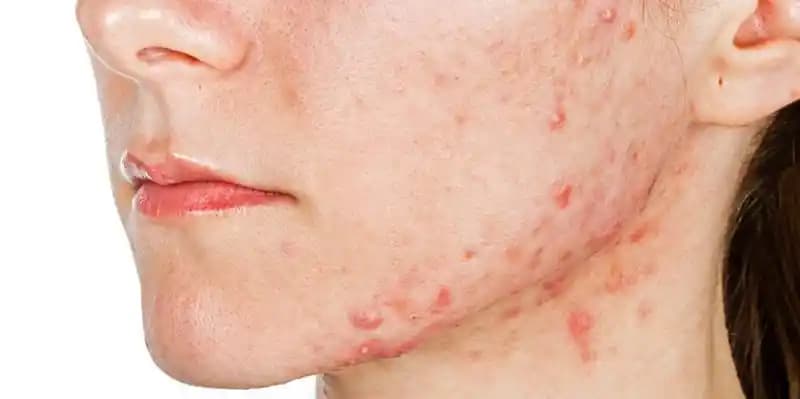 İltihaplı Sivilce Nedenleri ve Etkili Tedavi Yöntemleri Hakkında Kapsamlı Bilgi