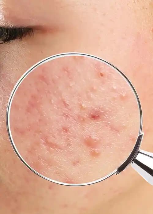 İltihapsız Sivilce Nedir ve Doğru Cilt Bakımıyla Kontrol Altına Alın