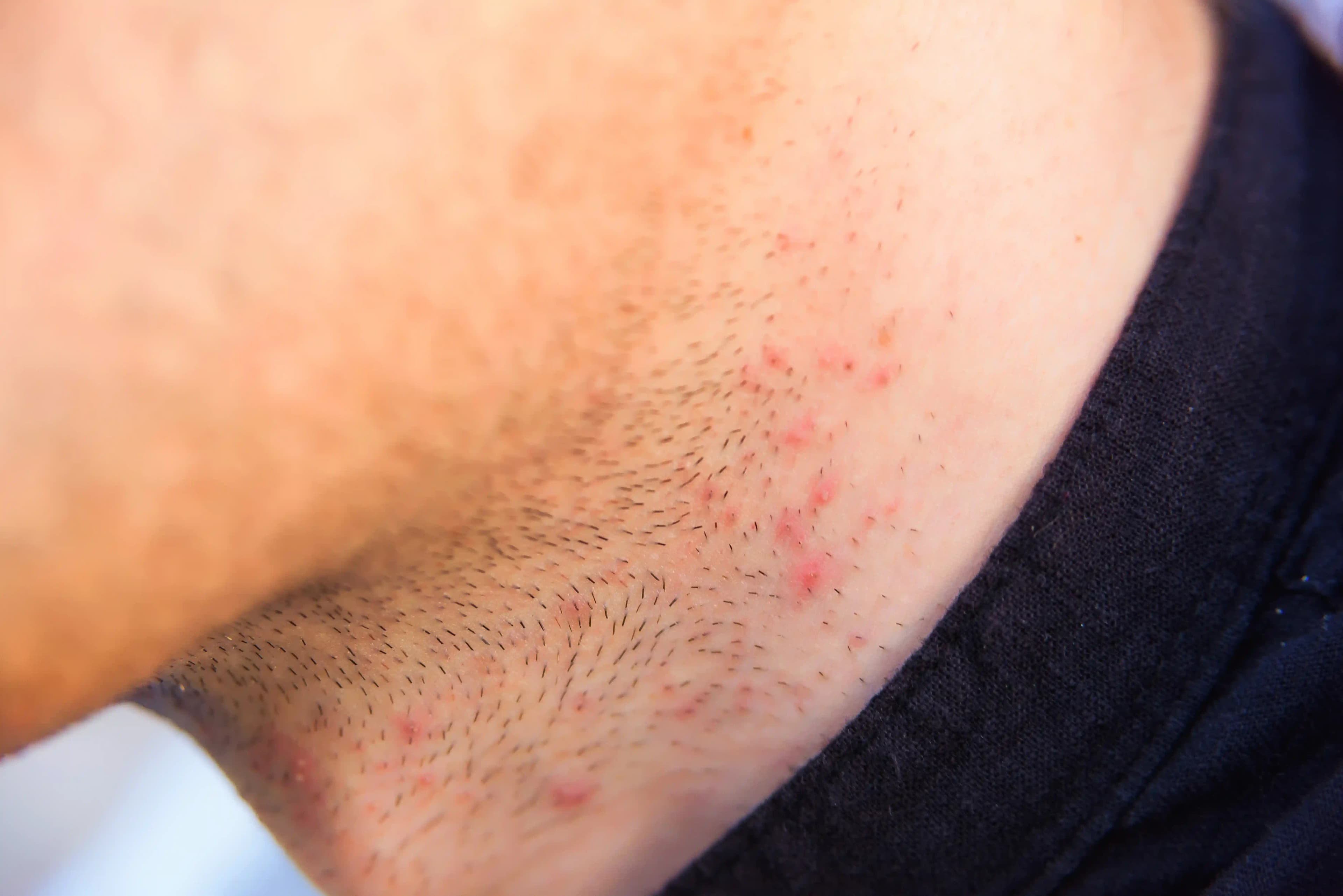 Jilet Sonrası Tahriş ve Batık Kıl Sorunlarına Çözüm: Etkili İpuçları ve Bakım Yöntemleri