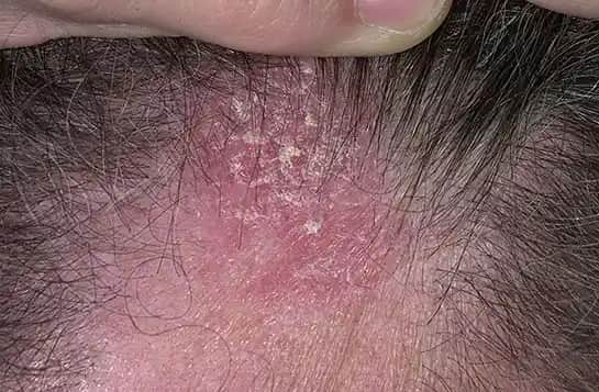 Kafa Derisinde Kırmızı Lekeler ve Kaşıntıya Karşı Etkili Çözümler ve Bakım Yöntemleri