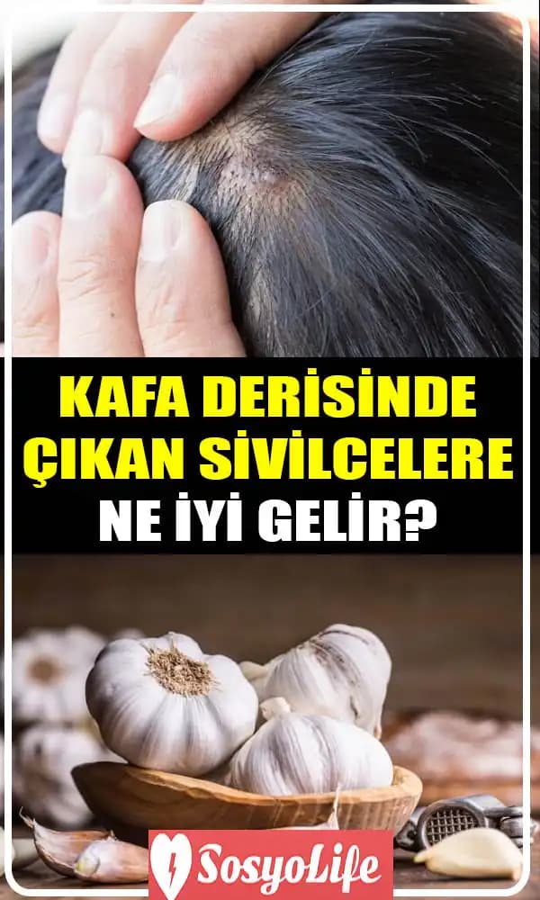 Kafa Derisinde Siyah Lekelerin Nedenleri ve Etkili Tedavi Yöntemleri