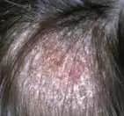 Kafa Mantarı Nedir Nasıl Geçer Uzman Tavsiyeleri ve Tedavi Yöntemleri