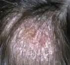 Kafa Mantarı Nedir Nasıl Geçer Uzman Tavsiyeleri ve Tedavi Yöntemleri