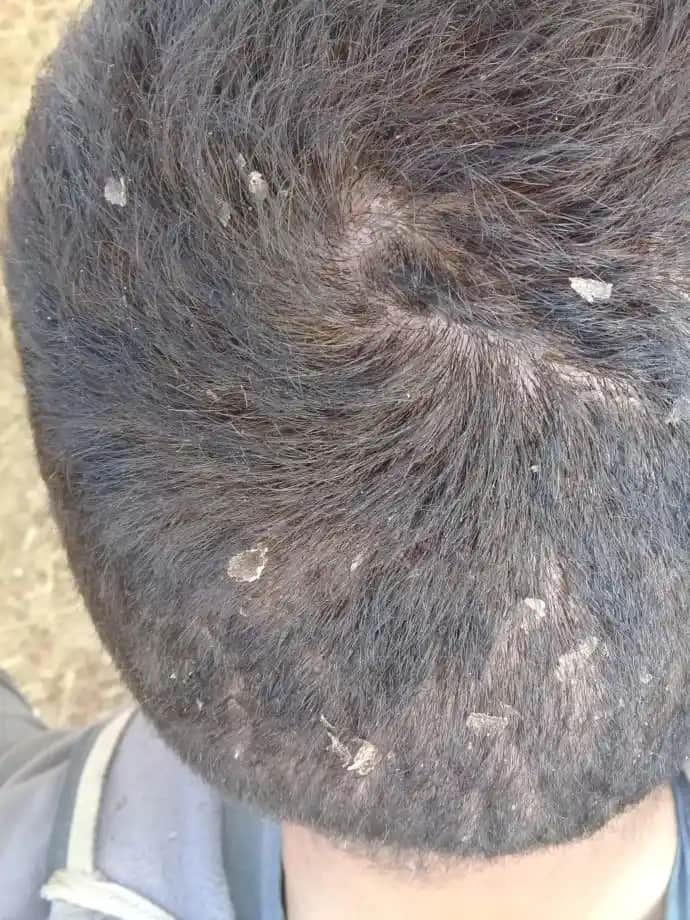 Kafada Deri Soyulmasının Nedenleri ve Etkili Çözüm Yolları