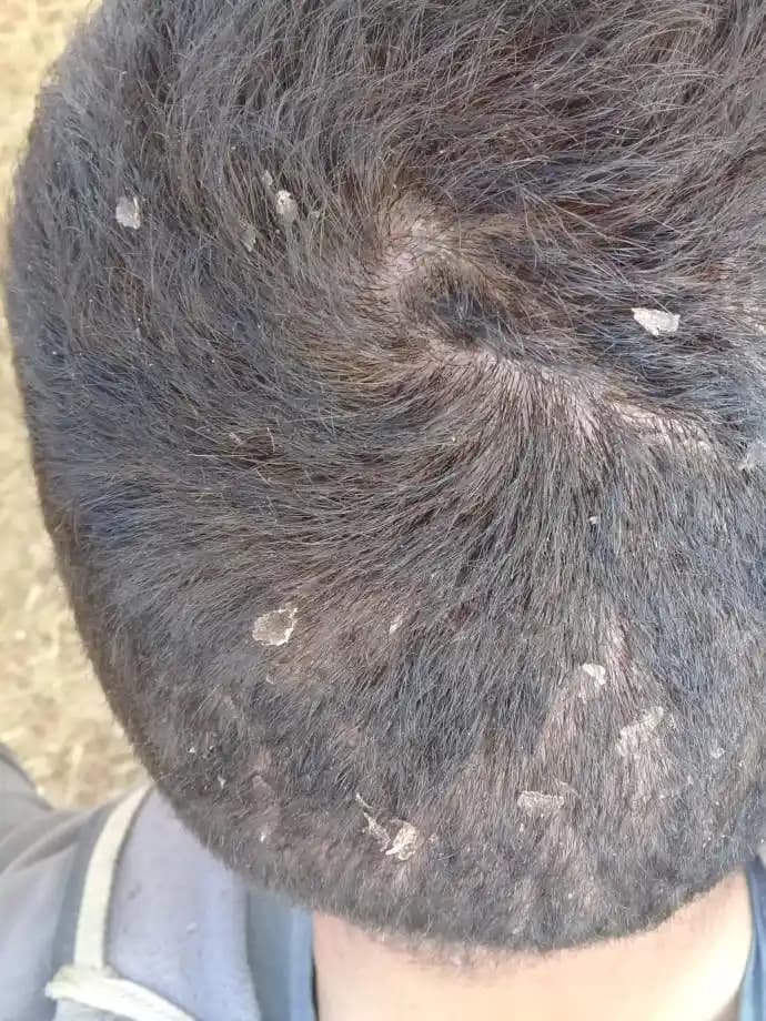 Kafada Deri Soyulmasının Nedenleri ve Etkili Çözüm Yolları