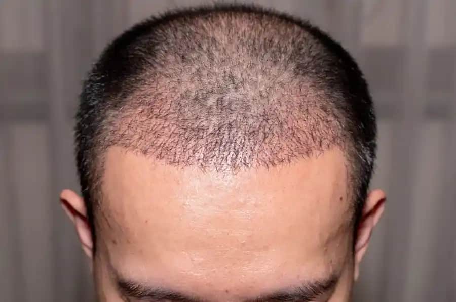 Kafada Şişlik ve Saç Dökülmesi Sorunlarıyla Mücadelede Doğru Bakım ve Kozmetik Yaklaşımlar