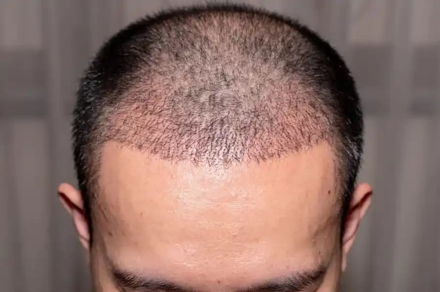 Kafada Şişlik ve Saç Dökülmesi Sorunlarıyla Mücadelede Doğru Bakım ve Kozmetik Yaklaşımlar