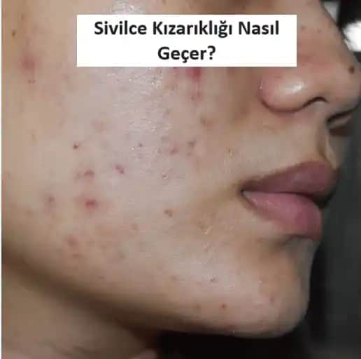 Kafadaki Sivilceler Nasıl Geçer: Nedenleri ve Etkili Çözüm Yöntemleri