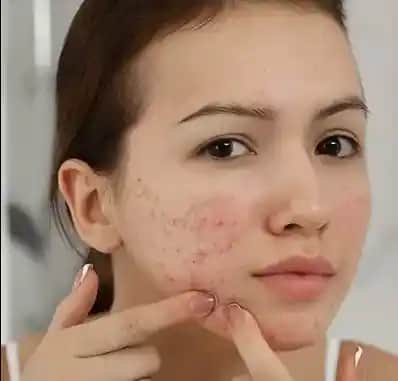 Kafein ve Sivilceler: Bilimsel Bulgularla Cilt Sağlığı Üzerindeki Etkileri