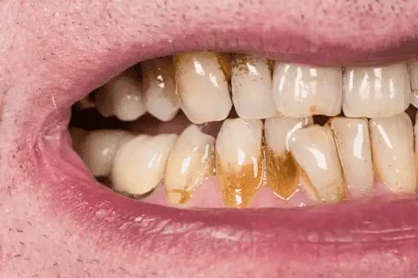 Kahve Lekeleriyle Mücadele Yöntemleri ve Kozmetik Çözümler