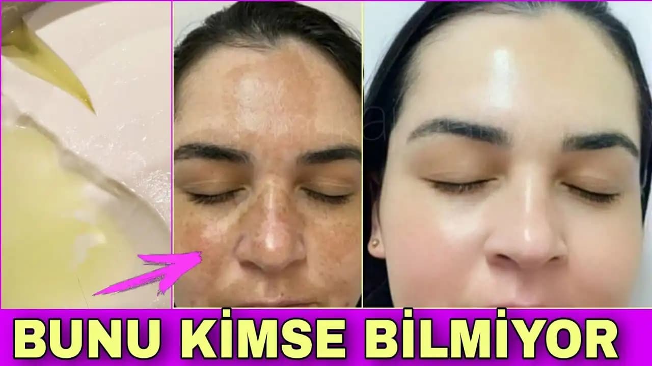 Kahverengi Güneş Lekeleri ve Kozmetik Yaklaşımlar: Oluşumu, Etkileri ve Tedavi Yöntemleri