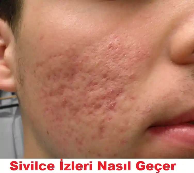 Kahverengi Sivilce İzleri Nasıl Azaltılır ve Cilt Yenileme Yöntemleri
