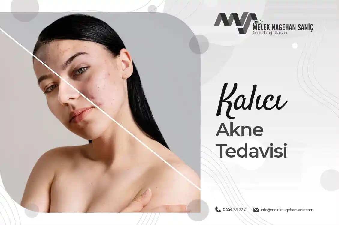Kalıcı Akne İzleri ve Tedavi Yöntemleri: Modern Dermatolojik Yaklaşımlar