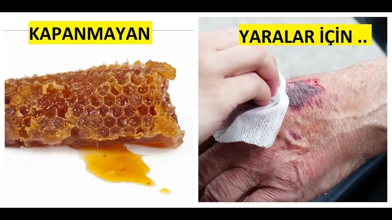 Kapanmayan Yaralar ve Güncel Tedavi Yöntemleri Hakkında Detaylı Bilgi