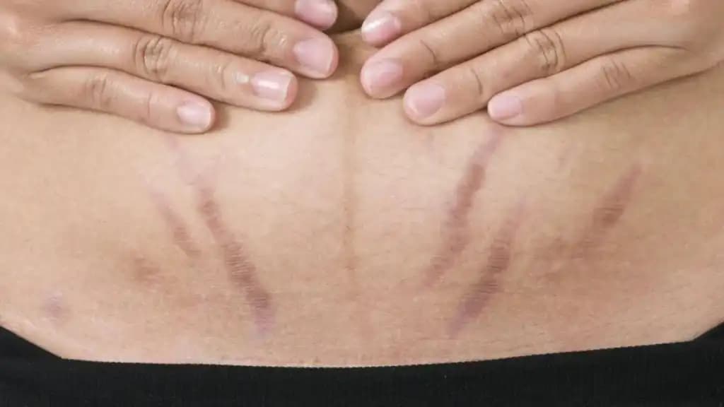 Karın Bölgesinde Egzama Nedenleri Belirtileri ve Etkili Çözüm Yolları