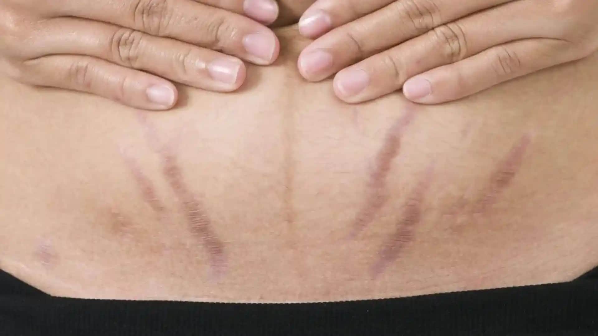 Karın Bölgesinde Kızarıklık: Kozmetik Bakımında Dikkat Edilmesi Gerekenler