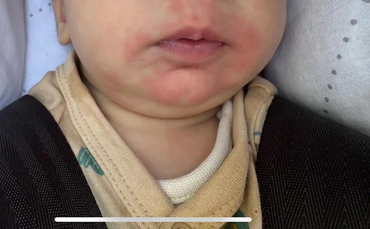 Karında Kızarıklık Nedenleri ve Kozmetik Ürünlerle İlişkisi Hakkında Bilgi