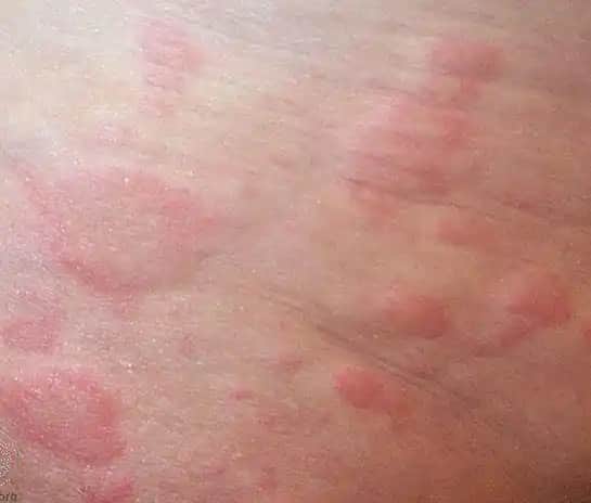 Karında Kızarıklık ve Kaşıntıya Neden Olan Faktörler ve Çözüm Yolları