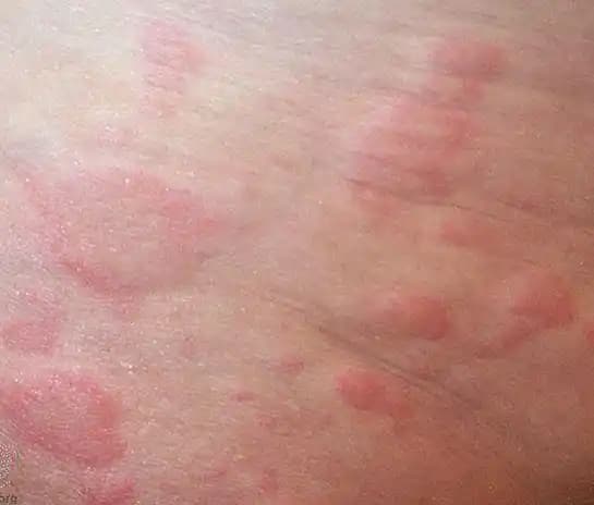 Karında Kızarıklık ve Kaşıntıya Neden Olan Faktörler ve Çözüm Yolları