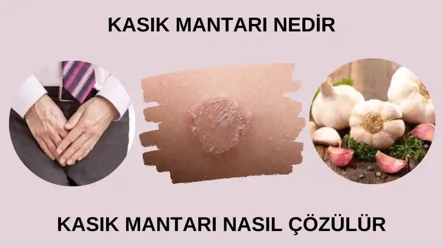 Kasık Arası Mantarına Karşı Etkili Doğal ve Kozmetik Çözümler Hakkında Bilgi