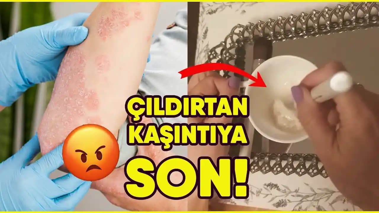 Kaşıntıya Evde Doğal ve Etkili Çözüm Yöntemleri Cilt Sağlığını Koruma