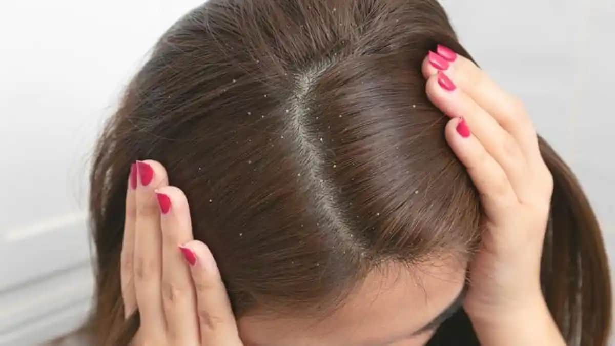 Kepek Nasıl Geçer Saç ve Deri Sağlığını Koruma Yöntemleri