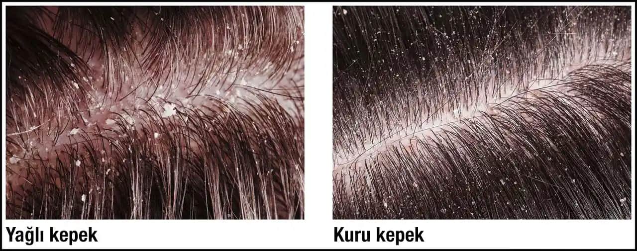 Kepek Neden Olur ve Etkili Çözüm Yolları Hakkında Detaylı Bilgi