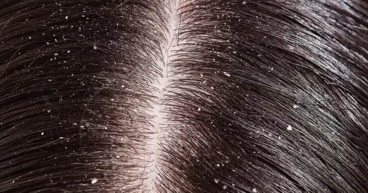 Kepek Nedenleri ve Çözüm Yolları Hakkında Kapsamlı Bilgi ve Tavsiyeler