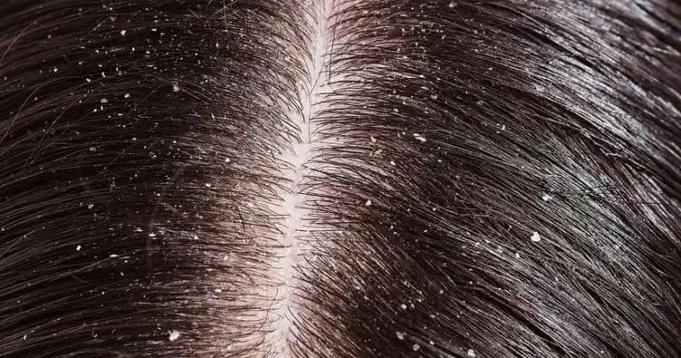 Kepek Nedenleri ve Çözüm Yolları Hakkında Kapsamlı Bilgi ve Tavsiyeler